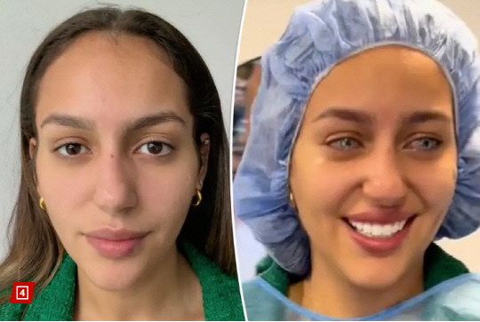 브라질의 한 모델이 이 수술을 받고 갈색 눈이 강렬한 파란색으로 바뀌었다. [SNS 캡처]